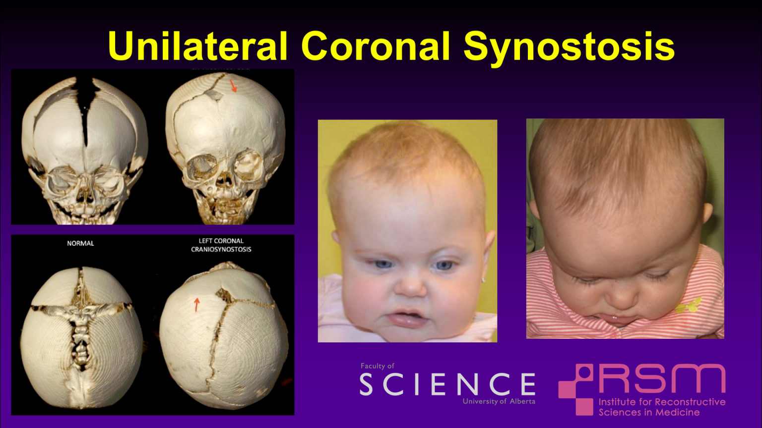 Improving Cranial Vault Remodeling for Unicoronal Craniosynostosis ...