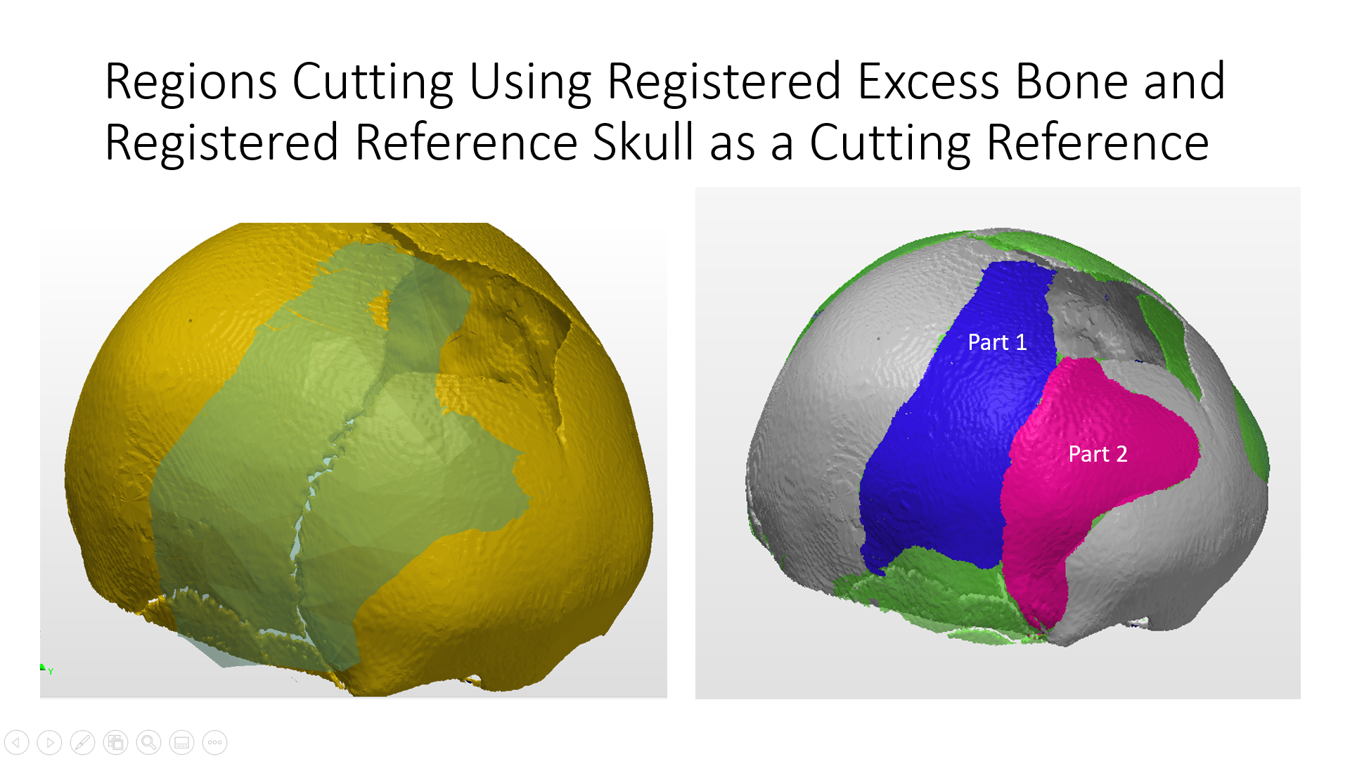 Improving Cranial Vault Remodeling for Unicoronal Craniosynostosis ...