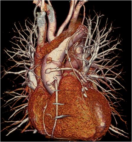 Arteries and Veins Using Coronary CT Angiography